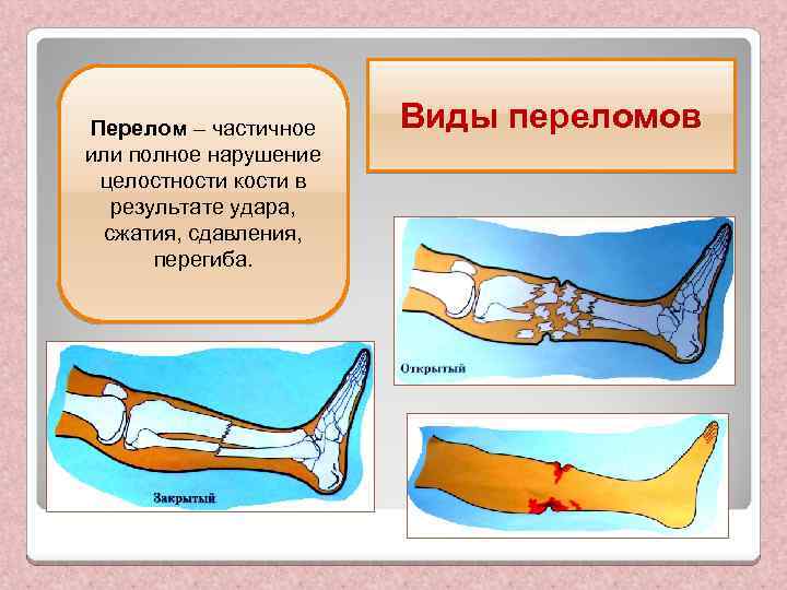 Перелом – частичное или полное нарушение целостности кости в результате удара, сжатия, сдавления, перегиба.