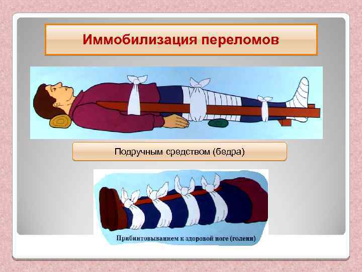 Иммобилизация переломов Подручным средством (бедра) 