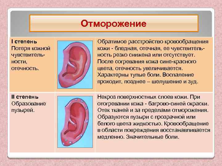 Отморожение Ι степень Потеря кожной чувствительности, отечность. Обратимое расстройство кровообращения кожи - бледная, отечная,