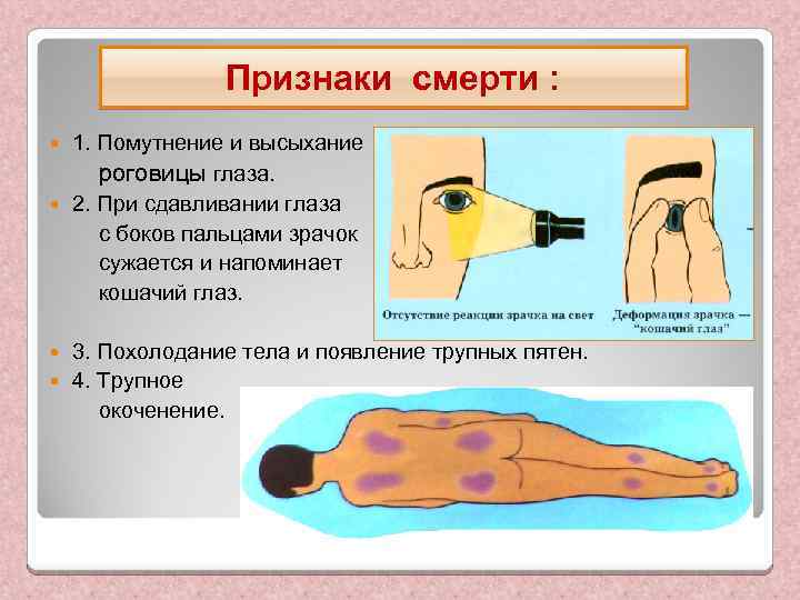 Признаки смерти : 1. Помутнение и высыхание роговицы глаза. 2. При сдавливании глаза с