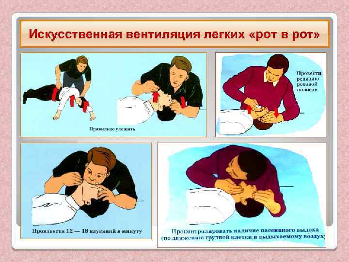 Искусственная вентиляция легких «рот в рот» 