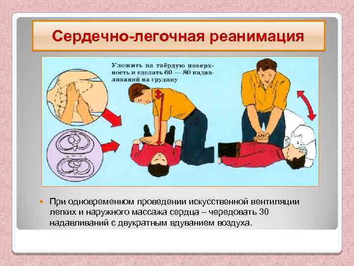 Сердечно-легочная реанимация При одновременном проведении искусственной вентиляции легких и наружного массажа сердца – чередовать