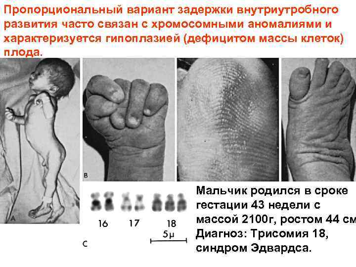 Пропорциональный вариант задержки внутриутробного развития часто связан с хромосомными аномалиями и характеризуется гипоплазией (дефицитом