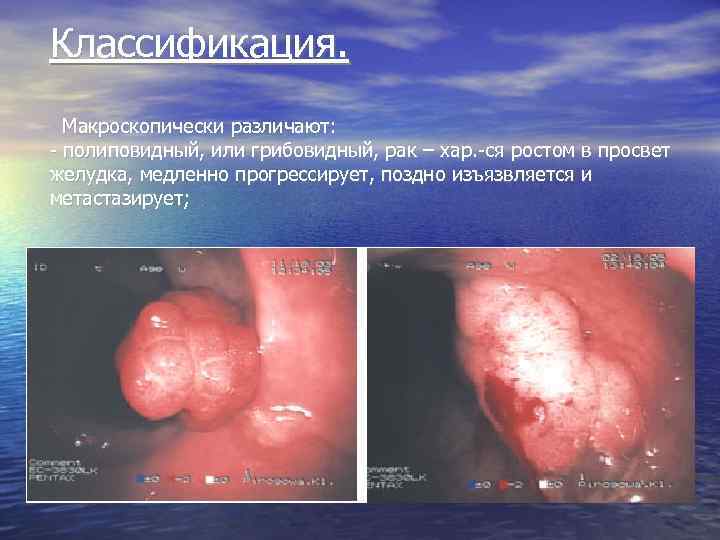 Классификация. Макроскопически различают: - полиповидный, или грибовидный, рак – хар. -ся ростом в просвет