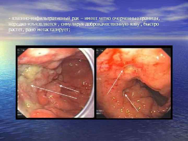 - язвенно-инфильтративный рак – имеет четко очерченные границы, нередко изъязвляется , симулируя доброкачественную язву