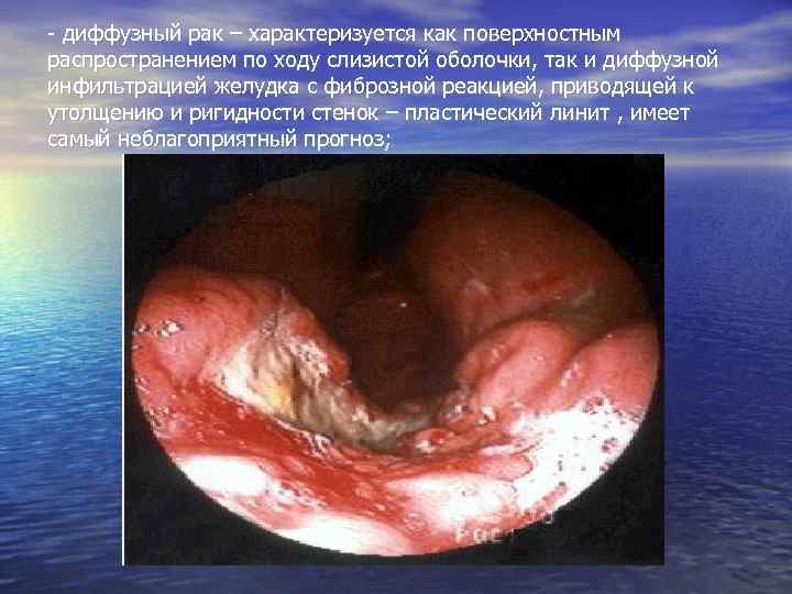 - диффузный рак – характеризуется как поверхностным распространением по ходу слизистой оболочки, так и