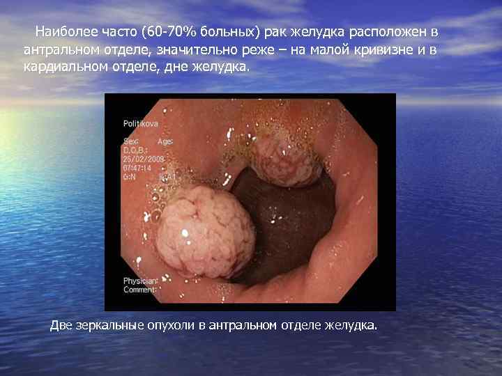  Наиболее часто (60 -70% больных) рак желудка расположен в антральном отделе, значительно реже