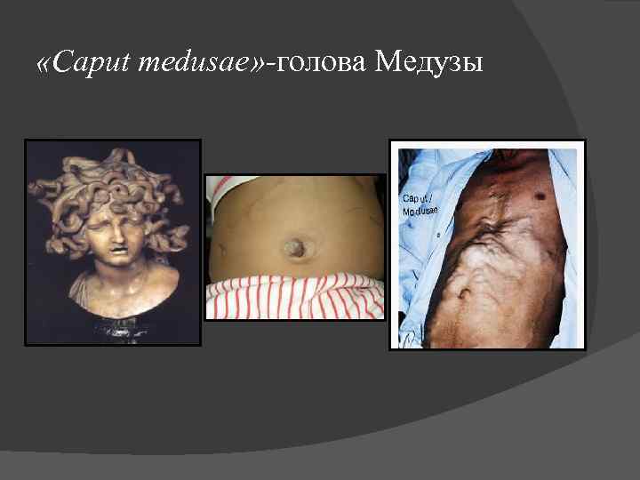  «Caput medusae» -голова Медузы 