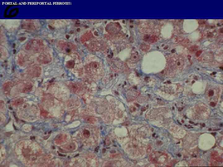 PORTAL AND PERIPORTAL FIBROSIS: 