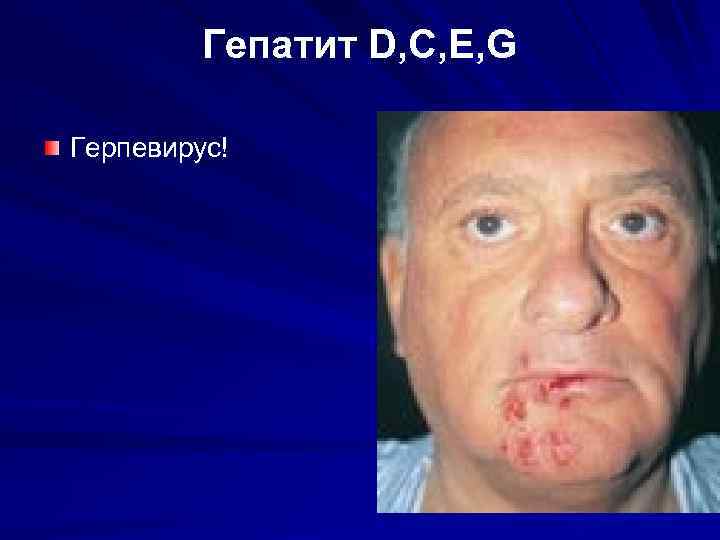 Гепатит D, C, E, G Герпевирус! 