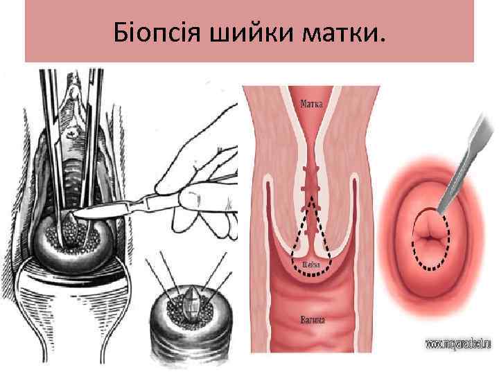 Біопсія шийки матки. 