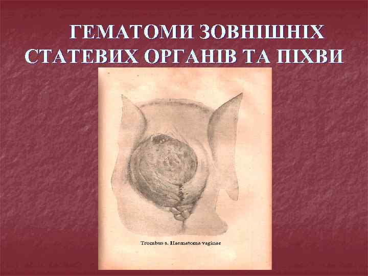 ГЕМАТОМИ ЗОВНІШНІХ СТАТЕВИХ ОРГАНІВ ТА ПІХВИ 