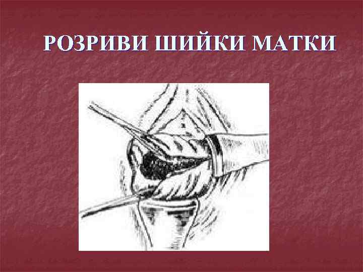 РОЗРИВИ ШИЙКИ МАТКИ 