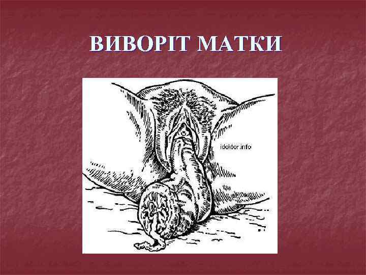 ВИВОРІТ МАТКИ 
