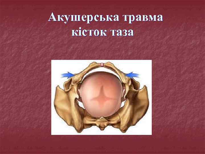 Акушерська травма кісток таза 