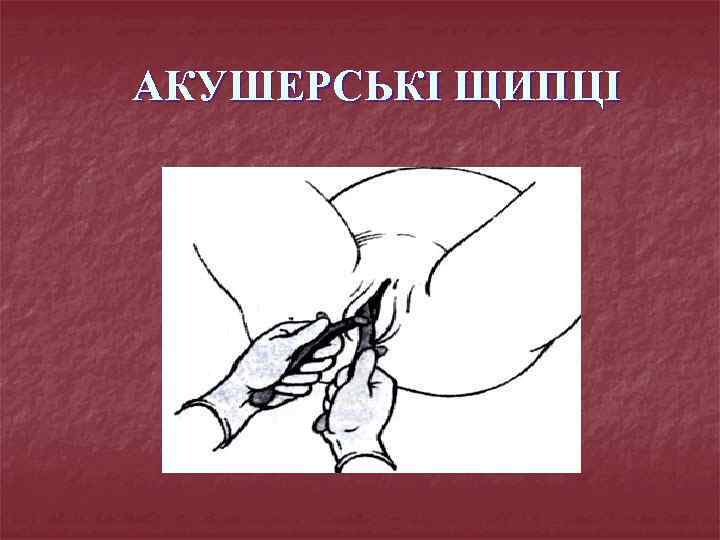 АКУШЕРСЬКІ ЩИПЦІ 