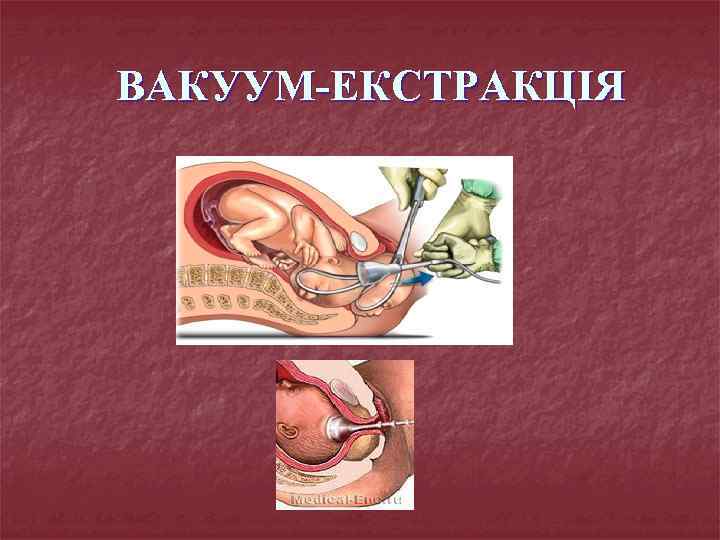ВАКУУМ-ЕКСТРАКЦІЯ 