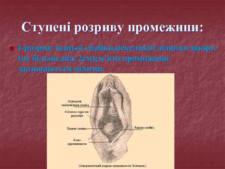 Ступені розриву промежини: n I-розрив задньої спайки, невеликої ділянки шкіри (не більше. ніж 2