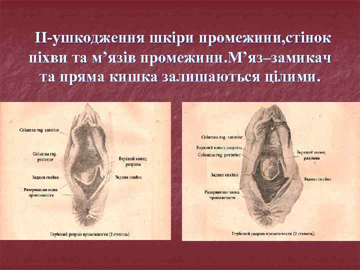 II-ушкодження шкіри промежини, стінок піхви та м’язів промежини. М’яз–замикач та пряма кишка залишаються цілими.