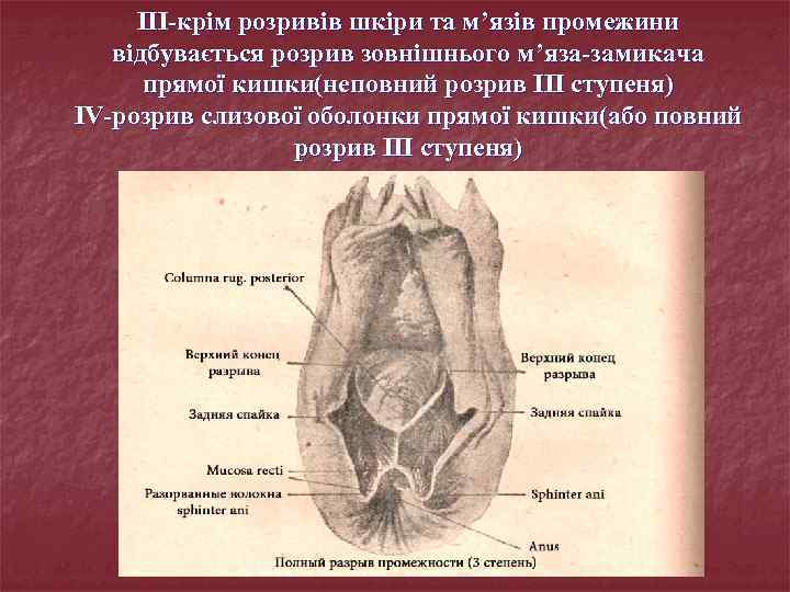 III-крім розривів шкіри та м’язів промежини відбувається розрив зовнішнього м’яза-замикача прямої кишки(неповний розрив III