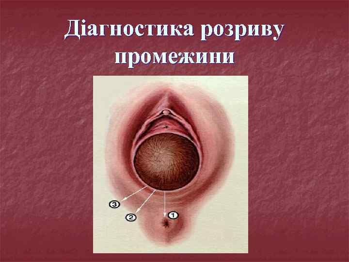 Діагностика розриву промежини 