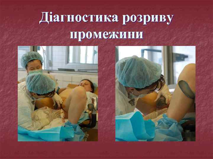 Діагностика розриву промежини 