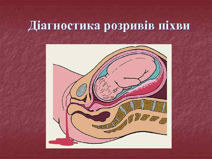 Діагностика розривів піхви 