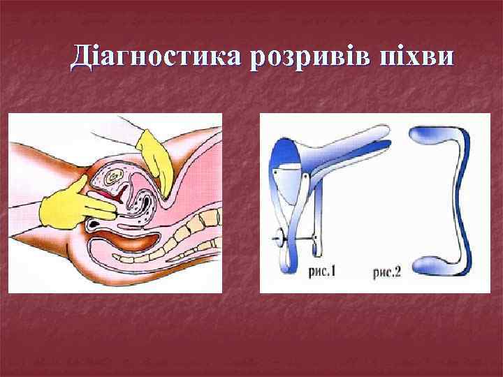 Діагностика розривів піхви 