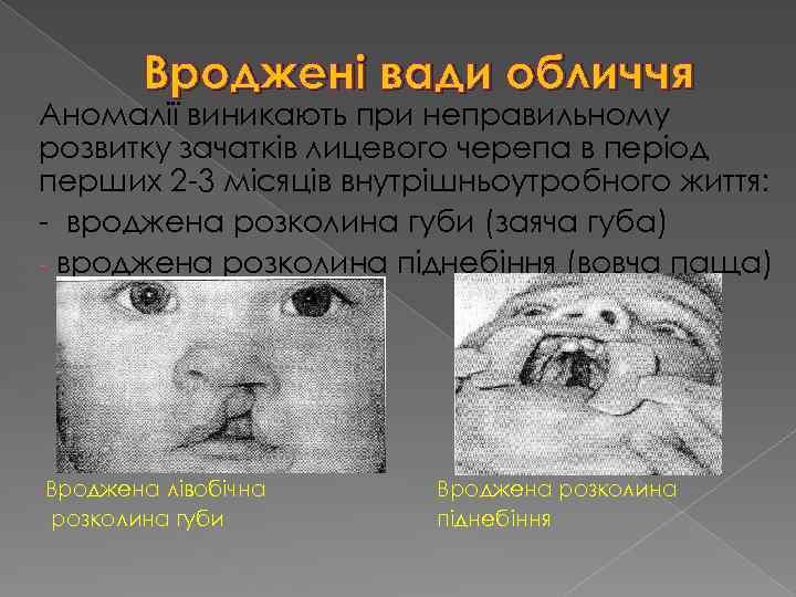 Вроджені вади обличчя Аномалії виникають при неправильному розвитку зачатків лицевого черепа в період перших