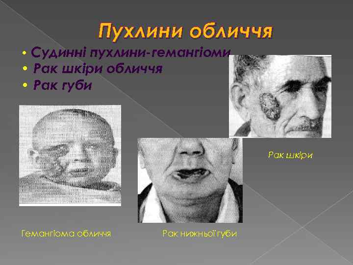  • Судинні Пухлини обличчя пухлини-гемангіоми • Рак шкіри обличчя • Рак губи Рак