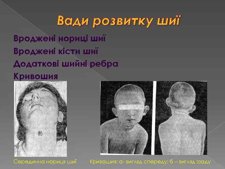 Вади розвитку шиї Вроджені нориці шиї Вроджені кісти шиї Додаткові шийні ребра Кривошия Серединна