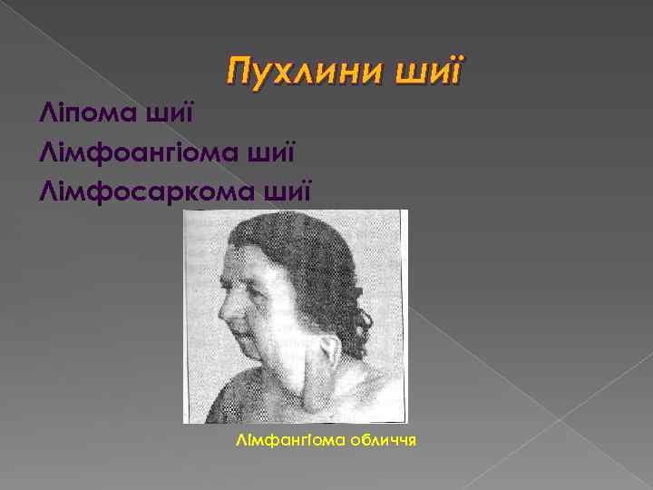 Пухлини шиї Ліпома шиї Лімфоангіома шиї Лімфосаркома шиї Лімфангіома обличчя 