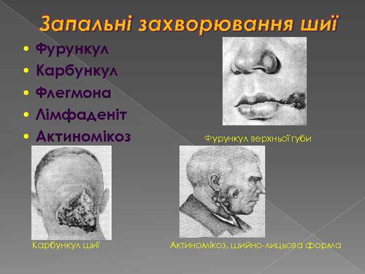 Запальні захворювання шиї • Фурункул • Карбункул • Флегмона • Лімфаденіт • Актиномікоз Карбункул