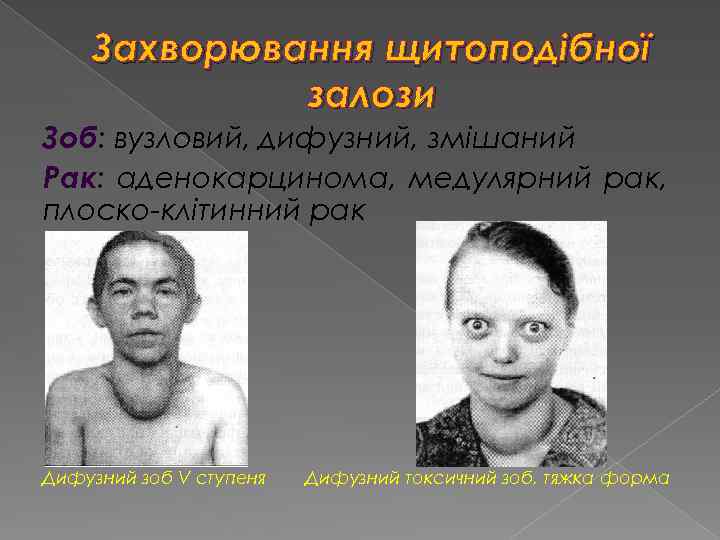 Захворювання щитоподібної залози Зоб: вузловий, дифузний, змішаний Рак: аденокарцинома, медулярний рак, плоско-клітинний рак Дифузний