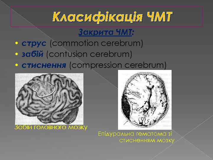 Класифікація ЧМТ Закрита ЧМТ: • струс (commotion cerebrum) • забій (contusion cerebrum) • стиснення