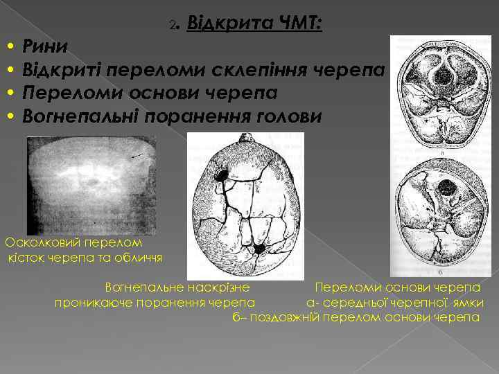 2. Відкрита ЧМТ: • Рини • Відкриті переломи склепіння черепа • Переломи основи черепа