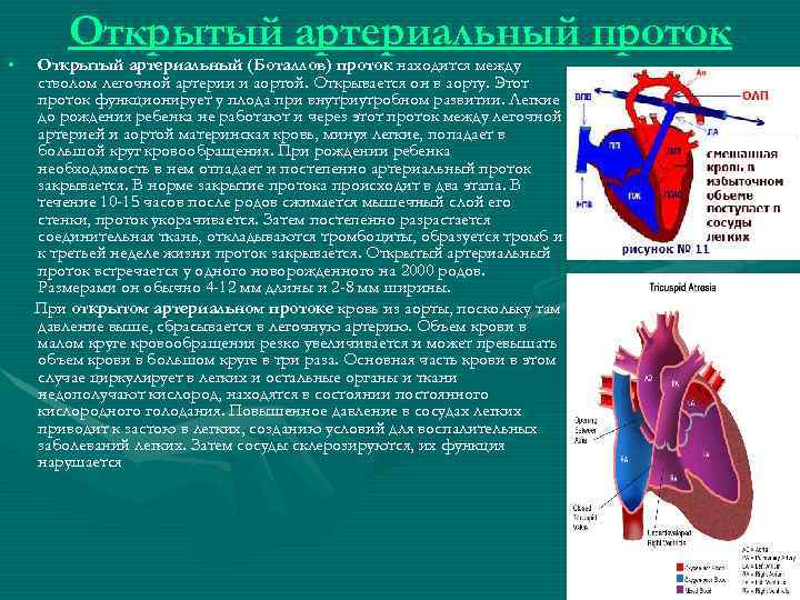 Открытый артериальный проток фото