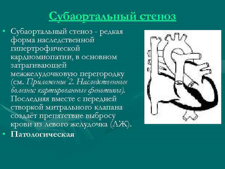 Субаортальный стеноз • Субаортальный стеноз - редкая форма наследственной гипертрофической кардиомиопатии, в основном затрагивающей