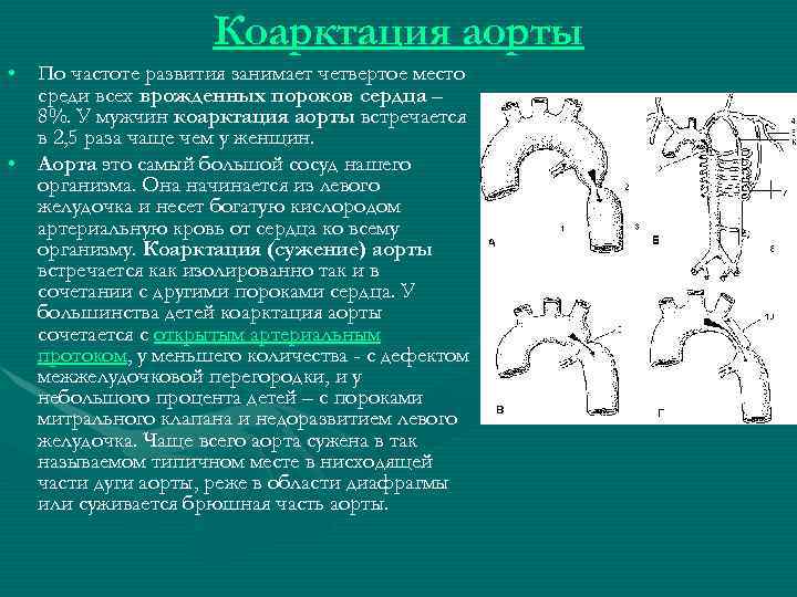 Коарктация аорты • По частоте развития занимает четвертое место среди всех врожденных пороков сердца