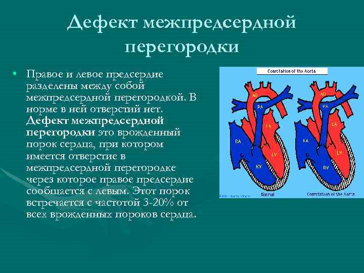 Дефект межпредсердной перегородки • Правое и левое предсердие разделены между собой межпредсердной перегородкой. В
