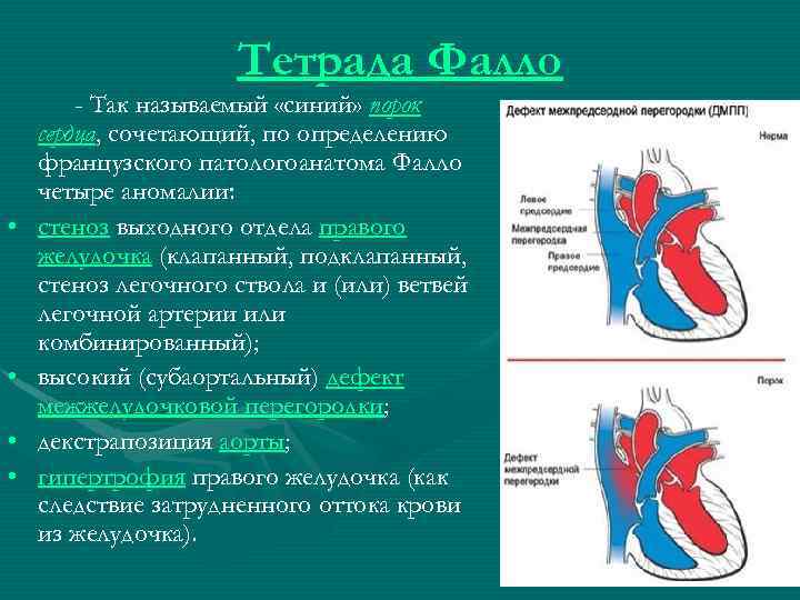 Тетрада Фалло • • - Так называемый «синий» порок сердца, сочетающий, по определению французского