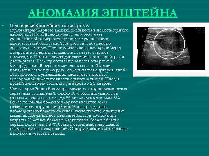АНОМАЛИЯ ЭПШТЕЙНА • • При пороке Эпштейна створки правого атриовентрикулярного клапана смещаются в полость