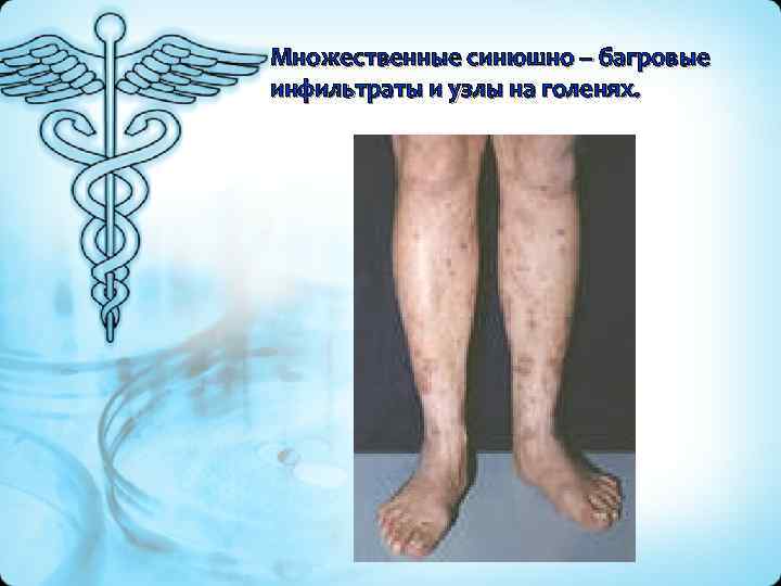 Множественные синюшно – багровые инфильтраты и узлы на голенях. 