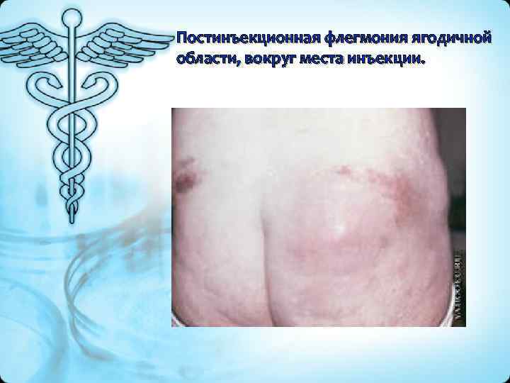 Постинъекционная флегмония ягодичной области, вокруг места инъекции. 