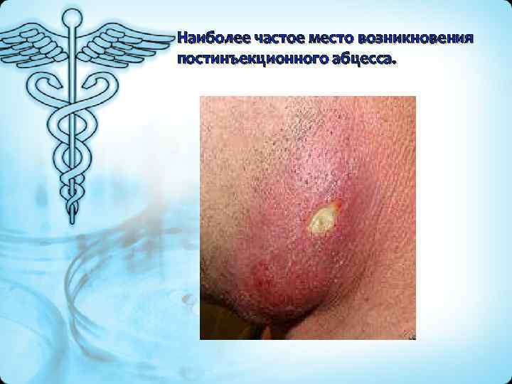 Наиболее частое место возникновения постинъекционного абцесса. 