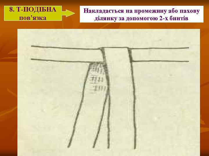8. Т-ПОДІБНА пов'язка Накладається на промежину або пахову ділянку за допомогою 2 -х бинтів