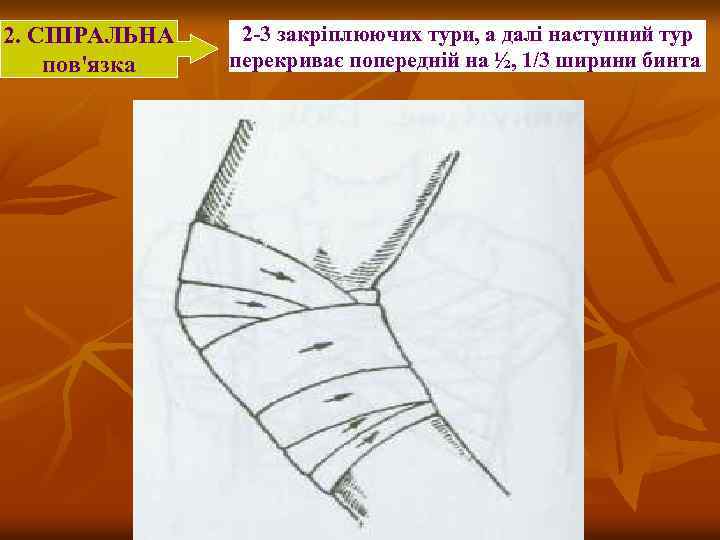 2. СПІРАЛЬНА пов'язка 2 -3 закріплюючих тури, а далі наступний тур перекриває попередній на