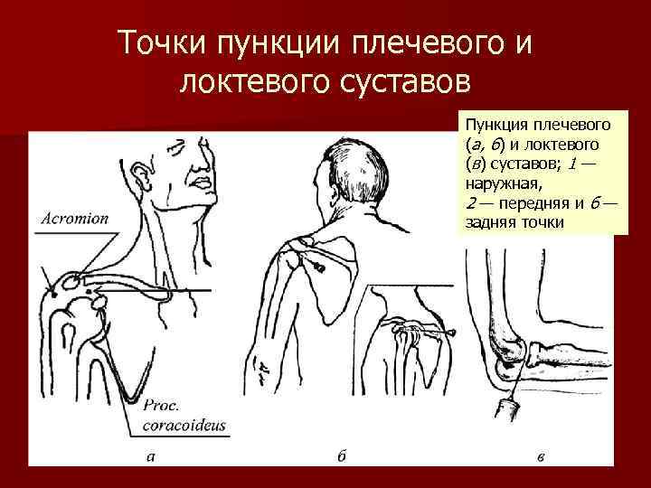 Точки пункции плечевого и локтевого суставов Пункция плечевого (а, б) и локтевого (в) суставов;