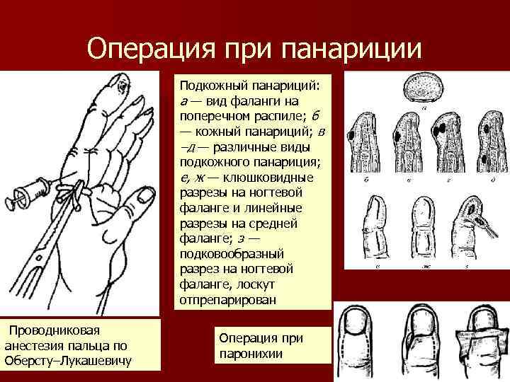 Операция при панариции Подкожный панариций: а — вид фаланги на поперечном распиле; б —