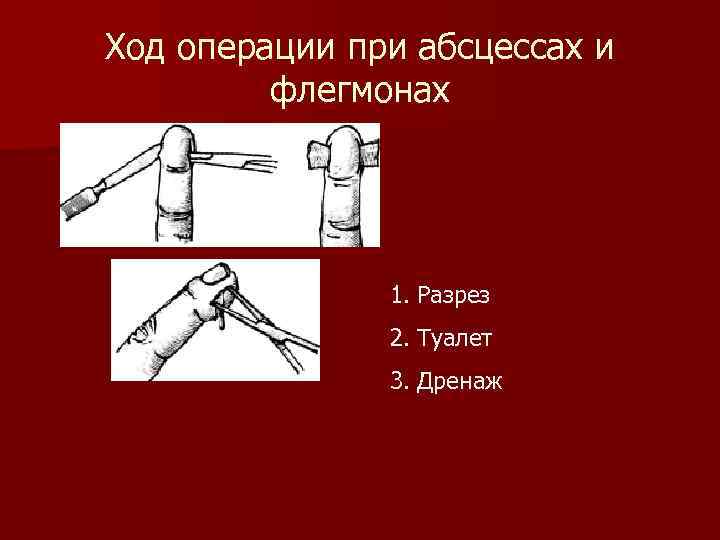 Ход операции при абсцессах и флегмонах 1. Разрез 2. Туалет 3. Дренаж 